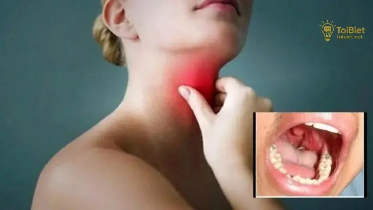 Cách Trị Hóc Xương Cá Ở Cổ Họng Tại Nhà Hiệu Quả 5 Phòng Tránh Hóc Xương Cá