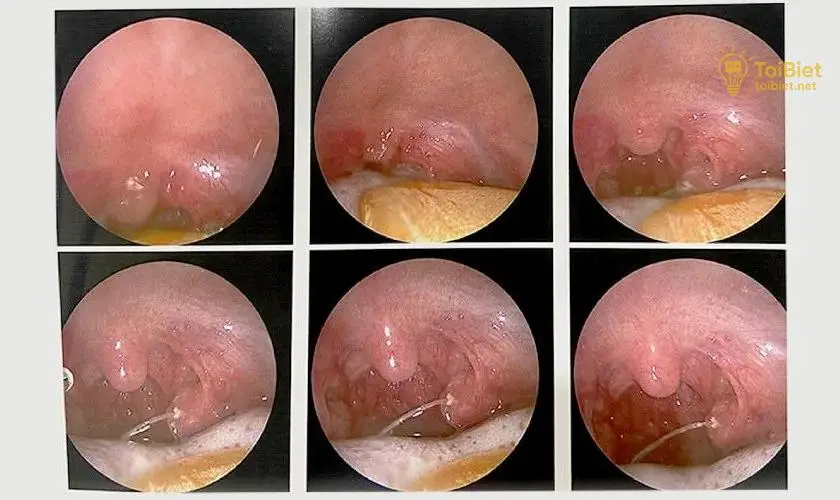 Cách Trị Hóc Xương Cá Ở Cổ Họng Tại Nhà Hiệu Quả 2 Các Phương Pháp Loại Bỏ Xương Cá Mắc Kẹt Tại Nhà