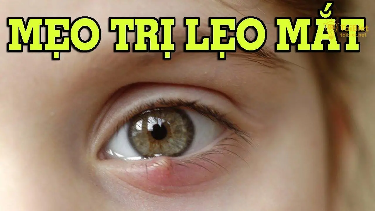 cach tri leo mat bang trung ga 68f1df5044818