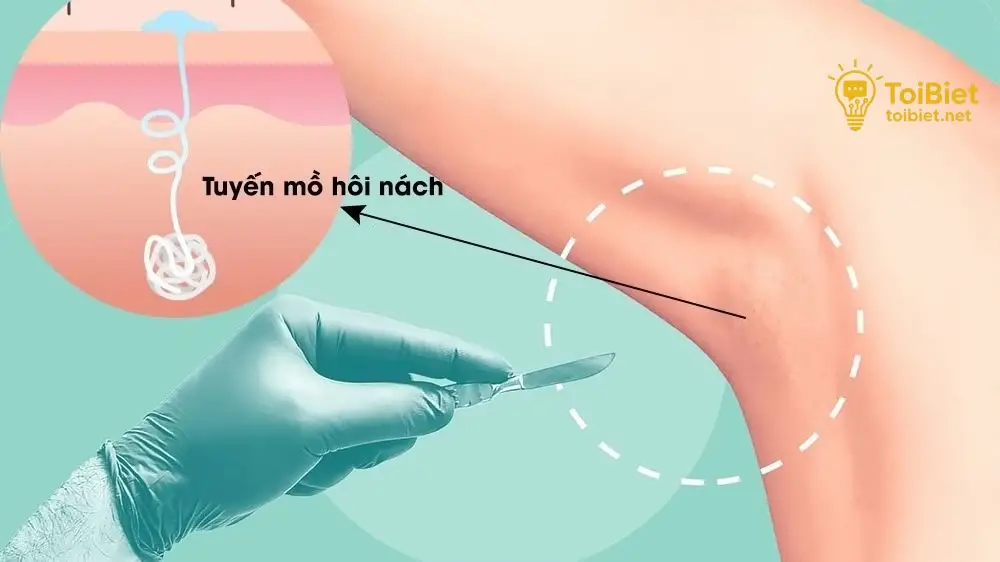 Phẫu Thuật Cắt Tuyến Mồ Hôi Nách