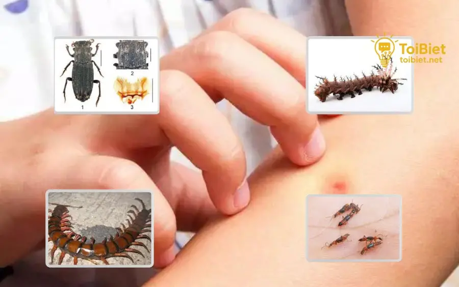 Đánh Giá Mức Độ Bỏng Đánh Giá Mức Độ Bỏng