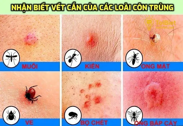 Nhận Biết Các Loại Côn Trùng Cắn Phổ Biến Nhận Biết Các Loại Côn Trùng Cắn Phổ Biến