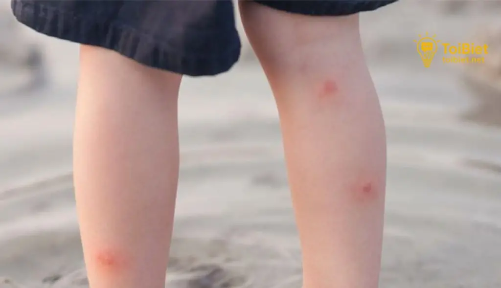 Các Bước Sơ Cứu Bỏng Nhẹ Các Bước Sơ Cứu Bỏng Nhẹ