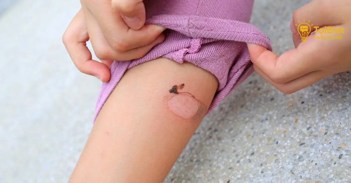 Chăm Sóc Vết Bỏng Tại Nhà Chăm Sóc Vết Bỏng Tại Nhà